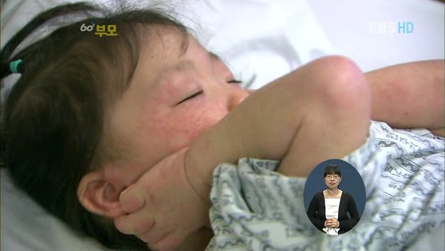 [60분부모] 아토피가 아이의 자존감을 낮춘다 ① | 인스티즈
