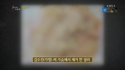 가슴성형의 그늘 | 인스티즈