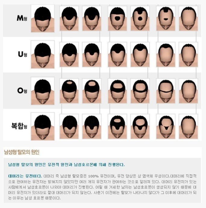탈모의 종류 | 인스티즈