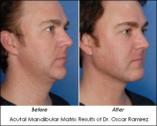 미국에서 많이하는 성형수술 세가지 | 인스티즈