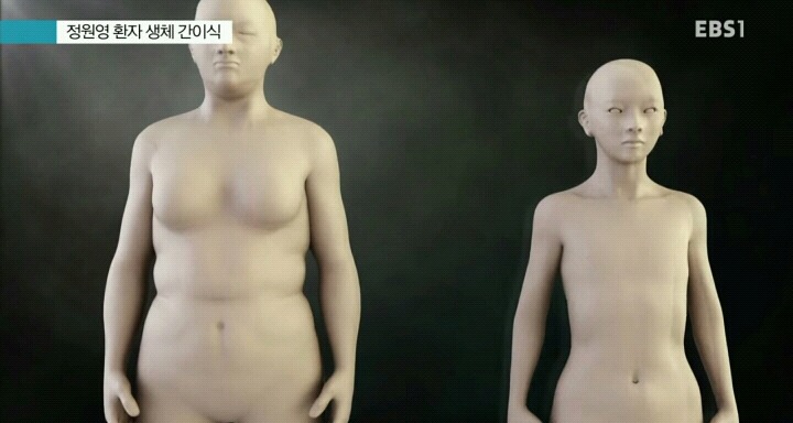 간이식수술 방법.jpg | 인스티즈