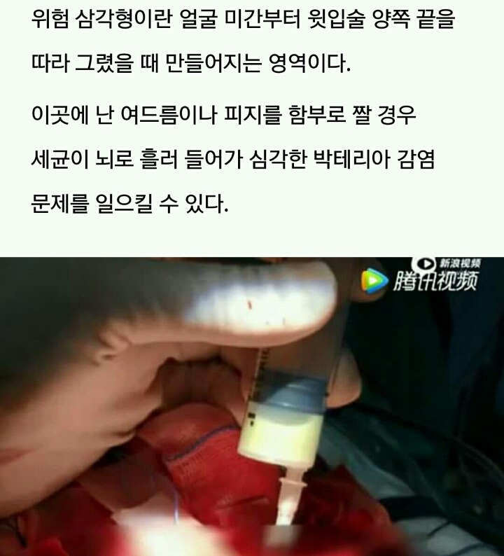 '위험 삼각형' 부분에 난 '블랙헤드' 짰다가 뇌종양 생긴 10세 소녀 | 인스티즈